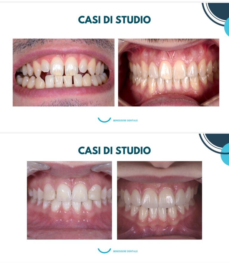 MEDICUS:PREMIO GENTILE DA FOLIGNO PRESENTA:DENTI E POSTURA